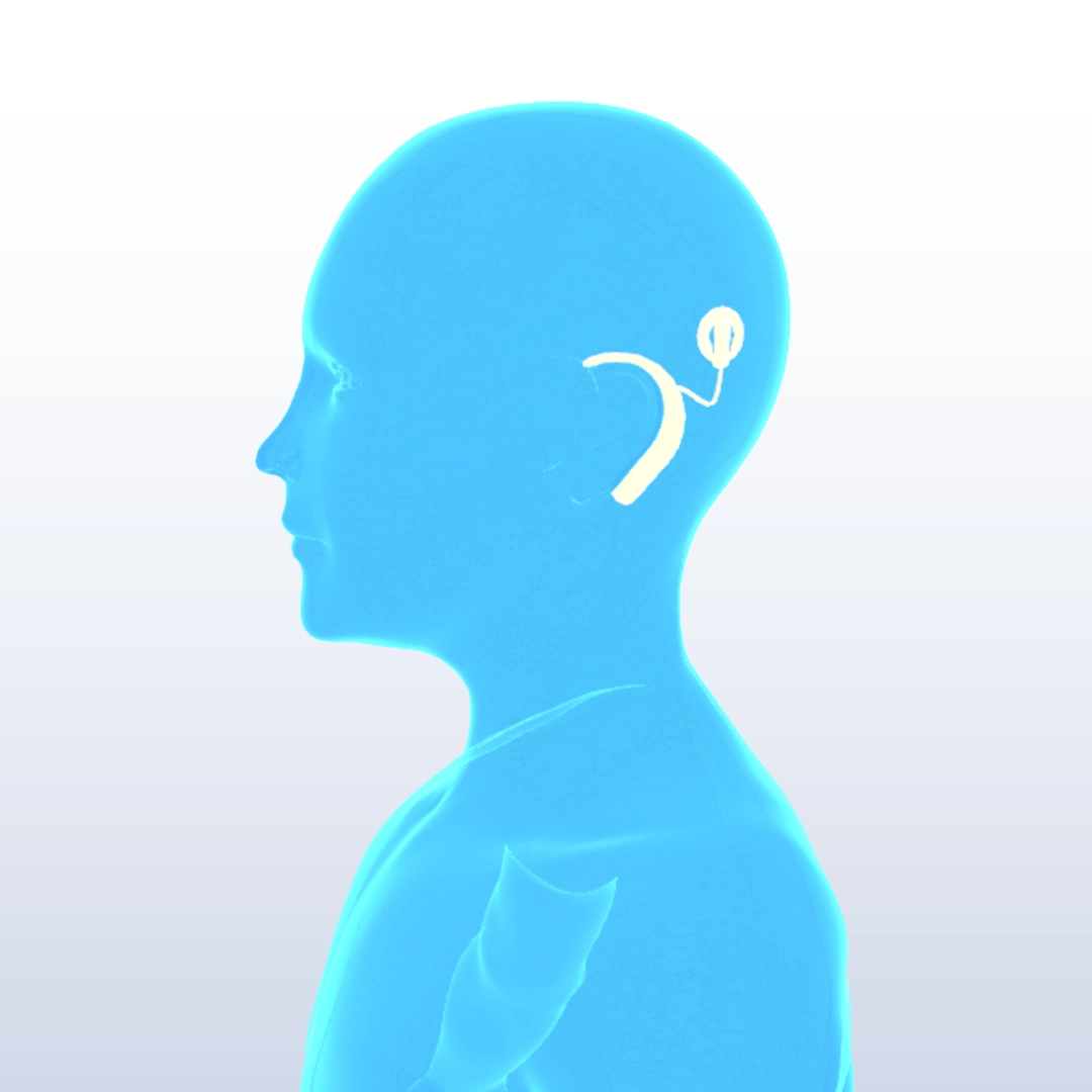 A blue, translucent side profile illustration of a person with a cochlear implant. The headpiece of the implant is visible behind the ear, with a connecting wire leading to an internal component. The background fades from light gray to lighter shades upwards.